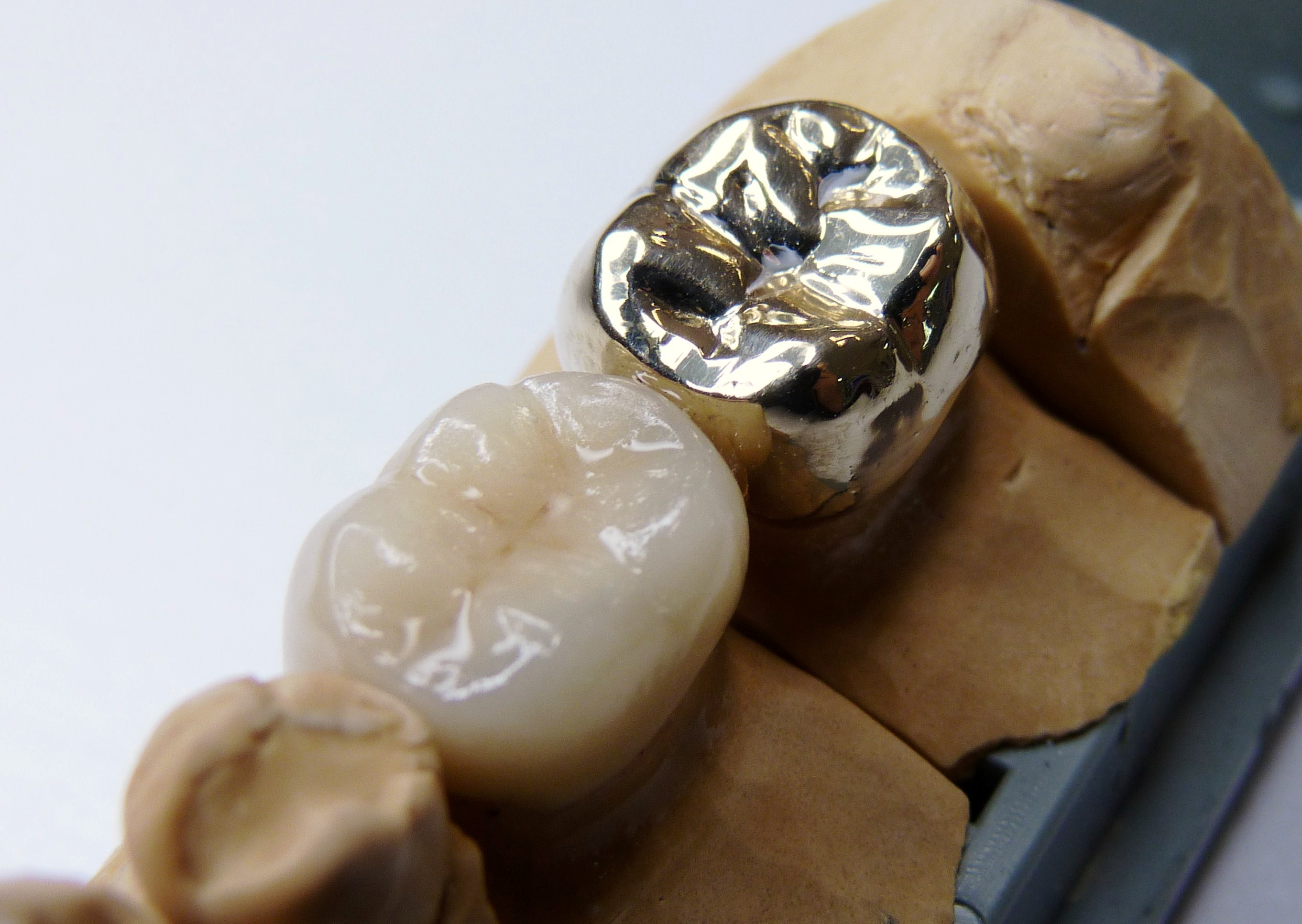 روکش فلزی دندان چیست 