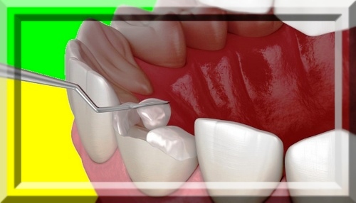 دلیل شکستن لمینت دندان چیست