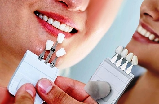 مزیت داشتن لمینت ثابت دندان (یا کامپوزیت) چیست
