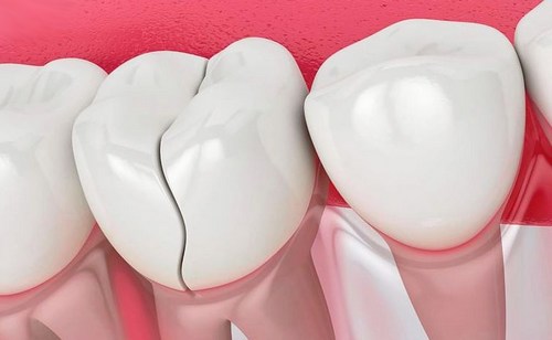 چرا دندان ها طبیعی ما می شکنند و اسیب میبیند
