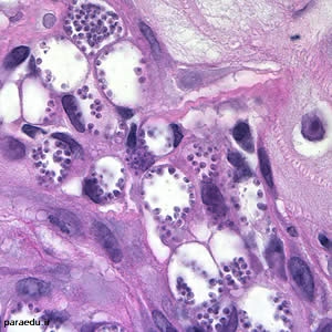 آماستیگوت های لیشمانیا. نمونه بیوپسی از ضایعه پوستی، رنگ آمیزی شده به روش هماتوکسیلین و ائوزین