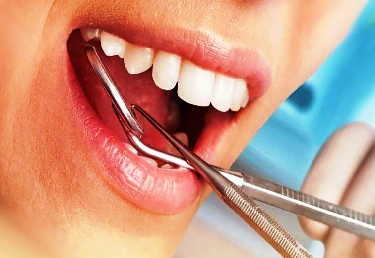 ساختار لمینت سرامیکی چگونه است + طریقه نگهداری لمینت کامپویت دندان سال 2024
