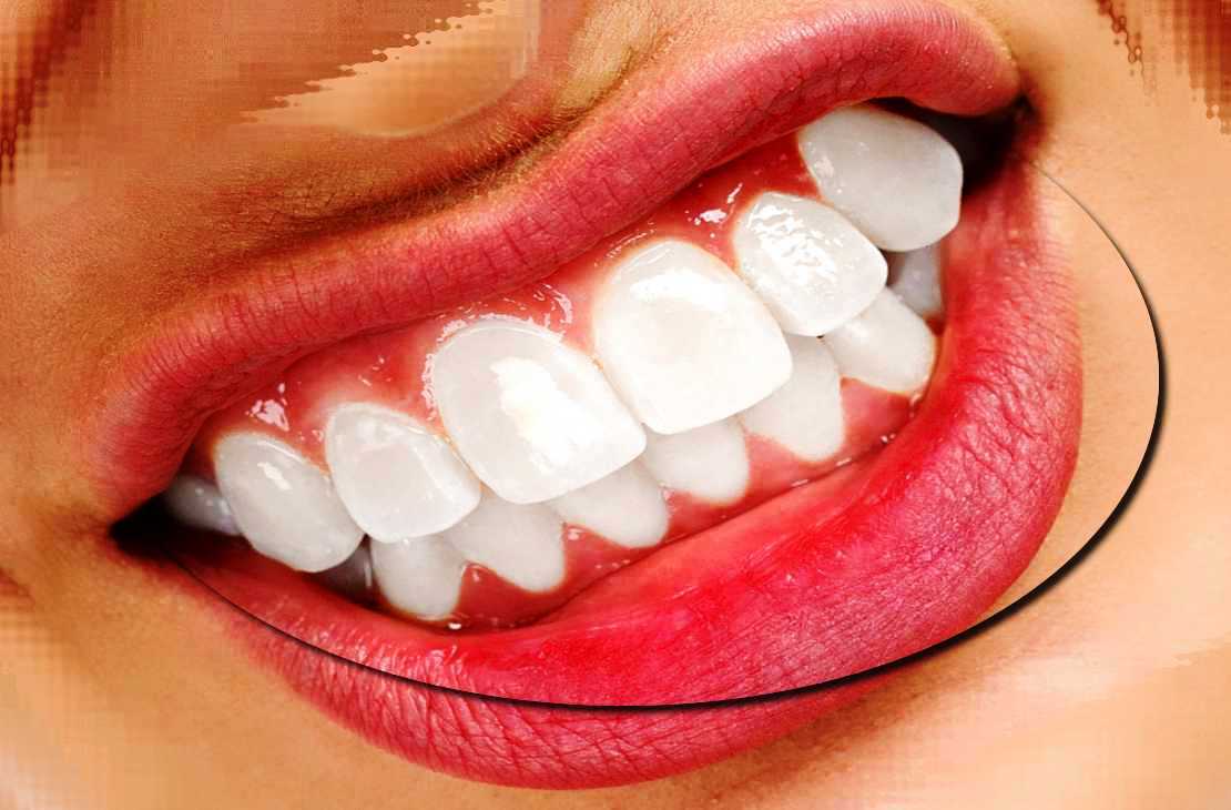 انواع کاربرد لمینت دندان چیست