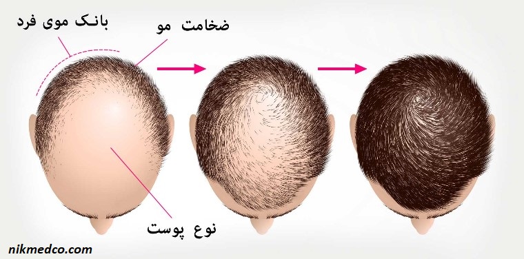 روش های نوین درمان ریزش مو و جوانسازی صورت