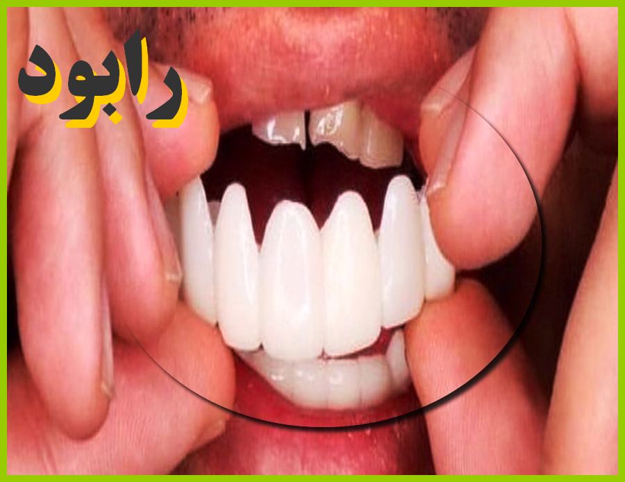 خمیر لمینت متحرک دندان